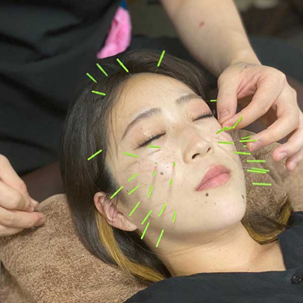 美容鍼